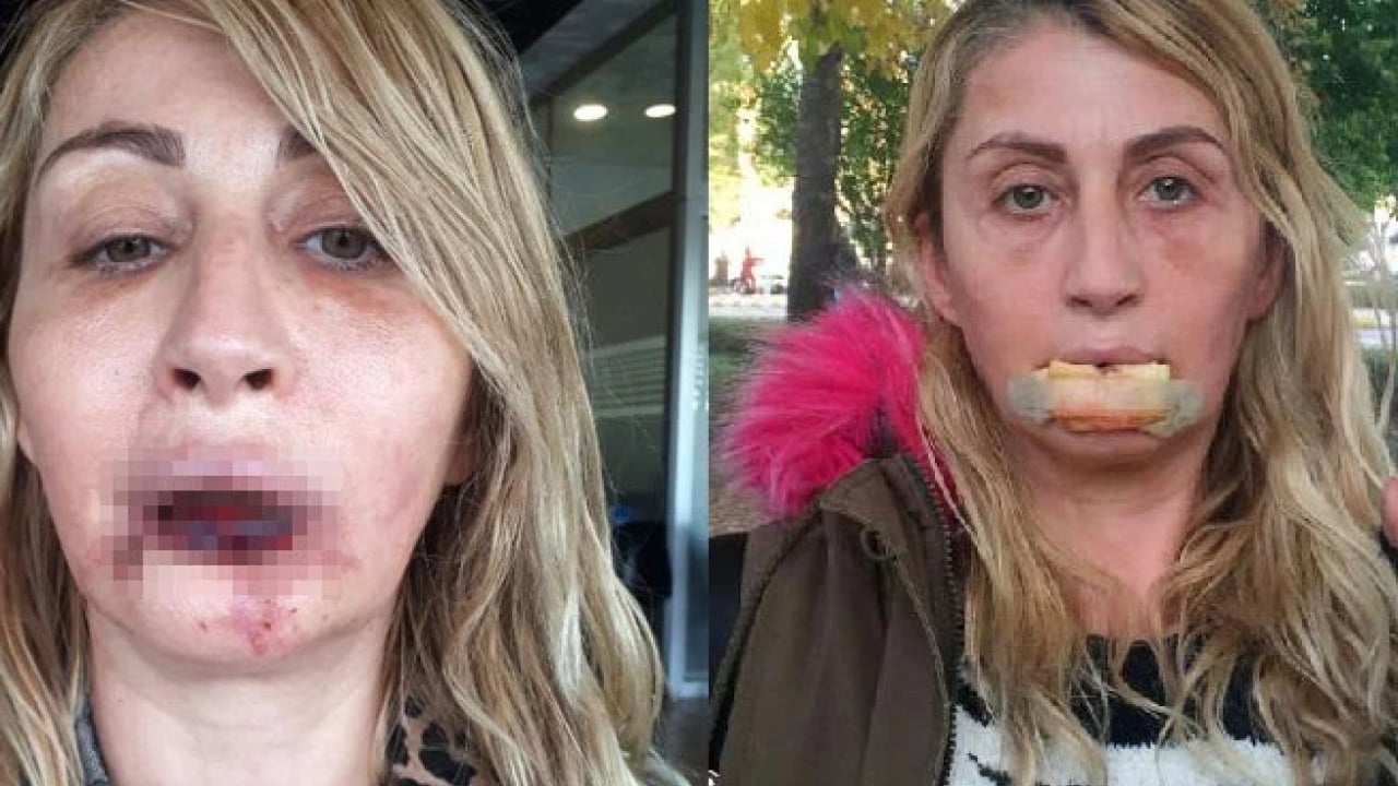 Foto - Yemek bile artık problem! Dolgu dudak hayat kararttı