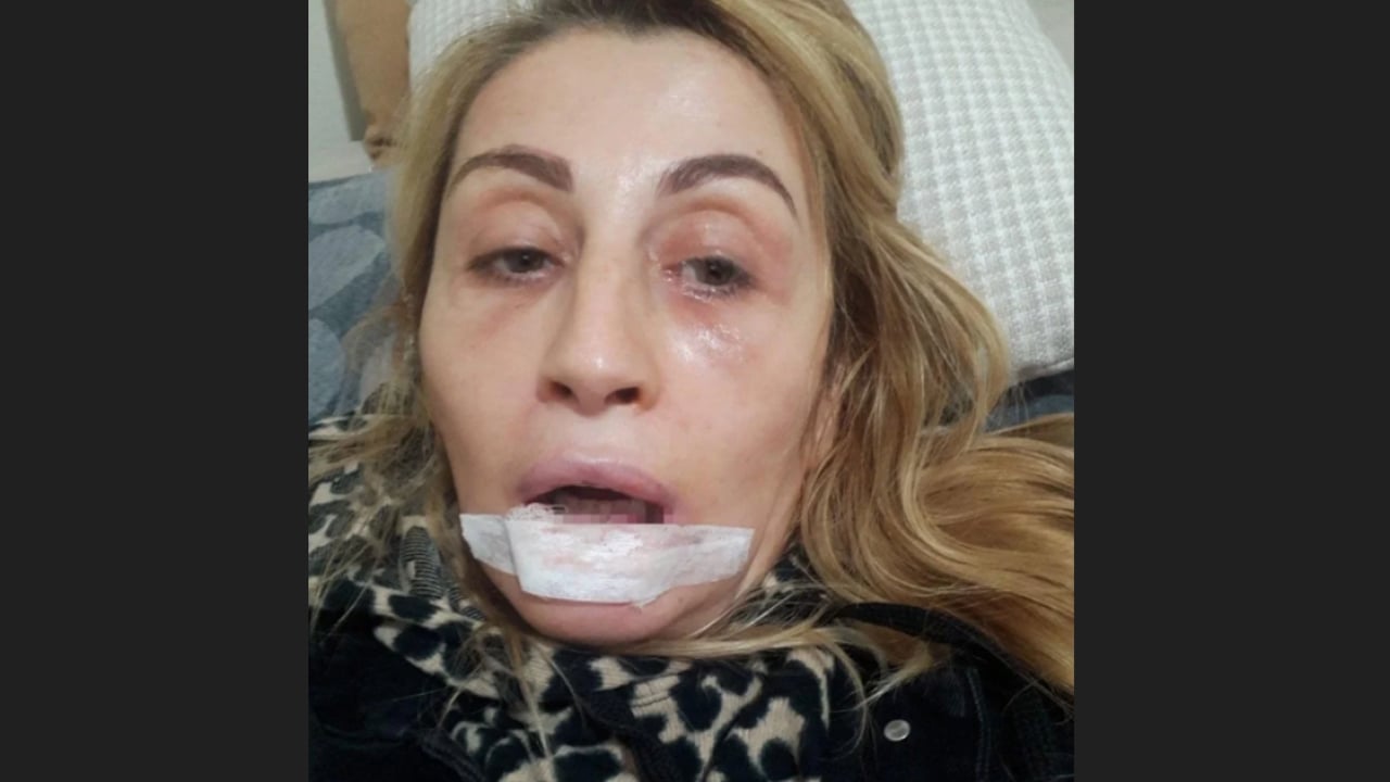 Foto - Yemek bile artık problem! Dolgu dudak hayat kararttı