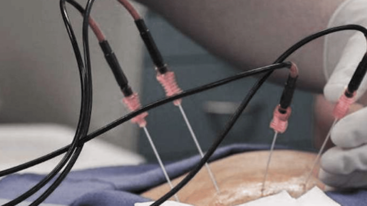 Foto - Yeni yöntemi belli oldu: Kronik ağrıların tedavisinde radyofrekans dönemi