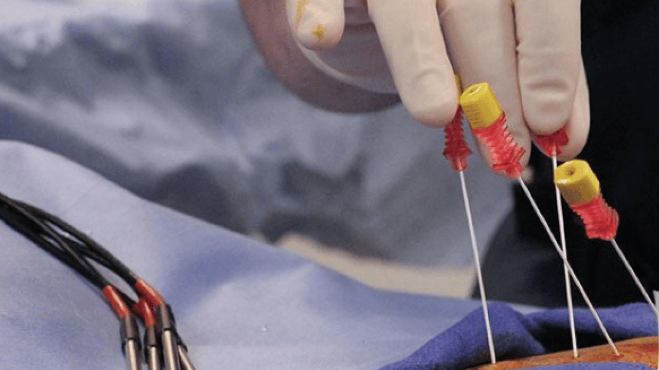 Foto - Yeni yöntemi belli oldu: Kronik ağrıların tedavisinde radyofrekans dönemi