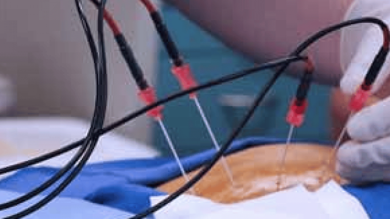 Foto - Yeni yöntemi belli oldu: Kronik ağrıların tedavisinde radyofrekans dönemi