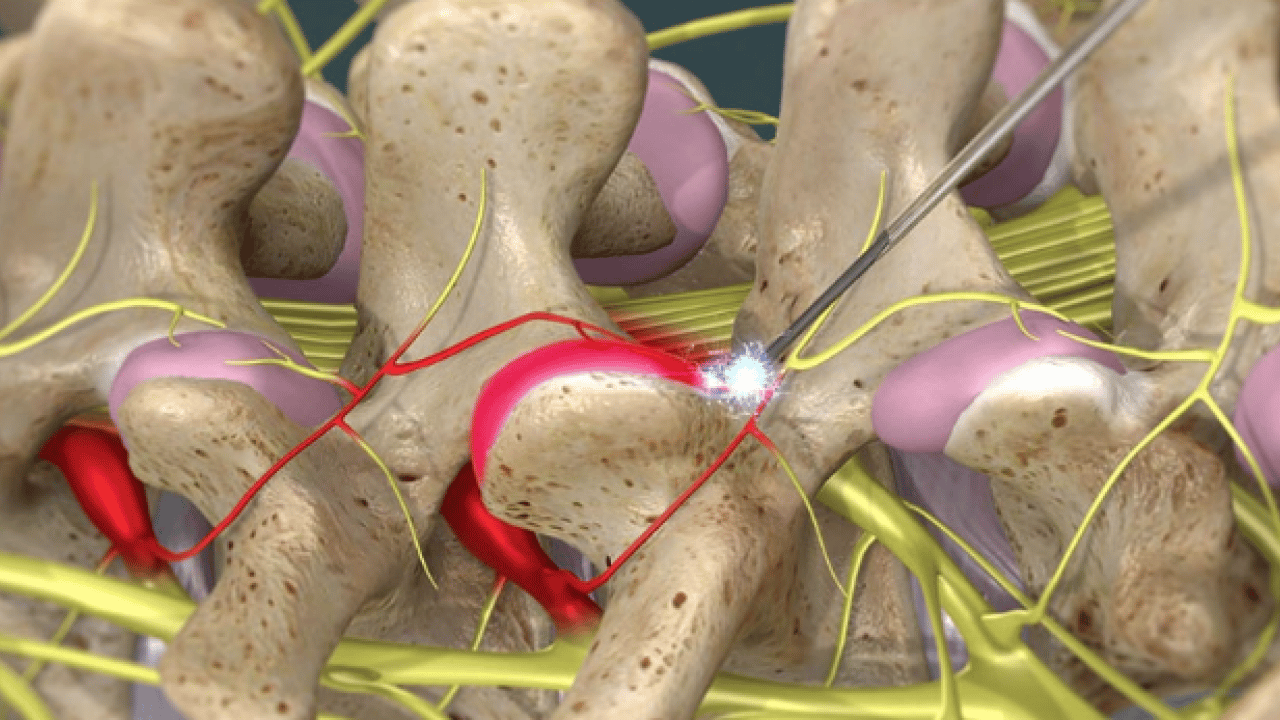 Foto - Yeni yöntemi belli oldu: Kronik ağrıların tedavisinde radyofrekans dönemi