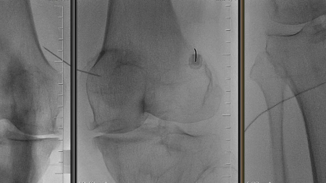 Foto - Yeni yöntemi belli oldu: Kronik ağrıların tedavisinde radyofrekans dönemi