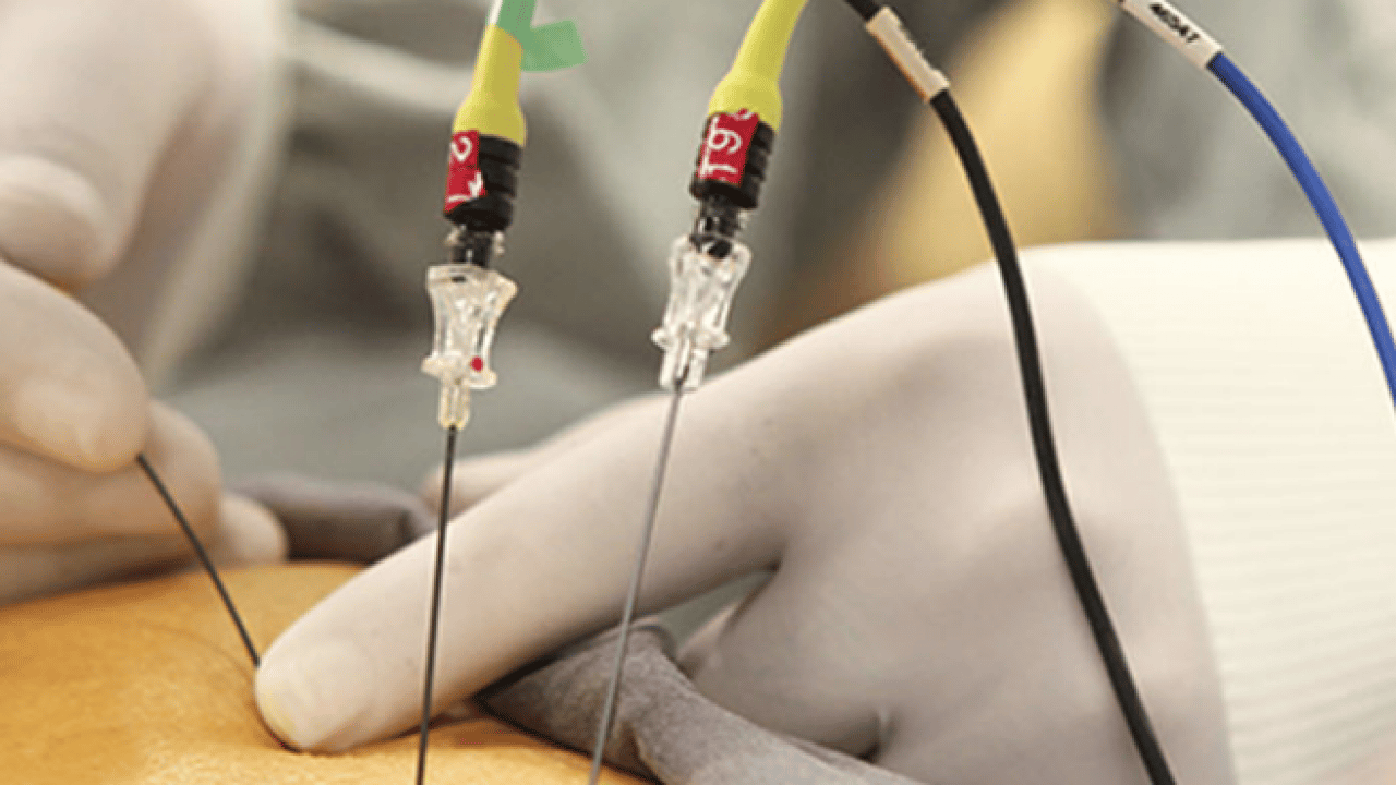 Foto - Yeni yöntemi belli oldu: Kronik ağrıların tedavisinde radyofrekans dönemi