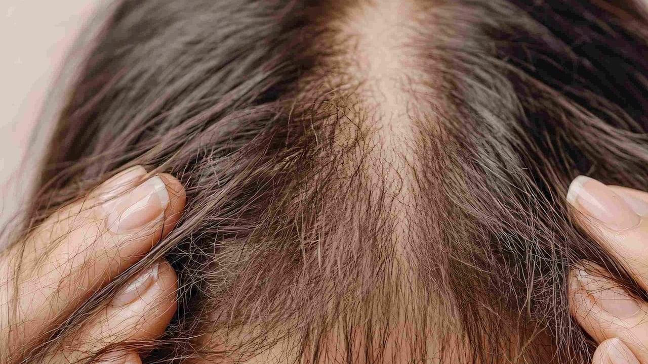 Foto - Yoğun saç dökülmesine karşı etkili önlemler böyle oluyor! Araştırma sonucu açıklandı: Yoğun stresin etkisi çıktı