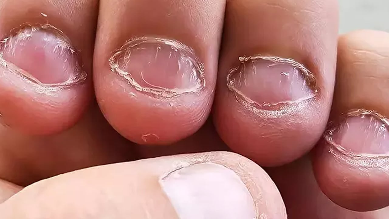 Foto - Yoğunluğu yaşanıyor! Uzmanlardan sık temas halinde tırnak iltihabı artırır açıklaması! Tırnak yemek neyin belirtisi olabilir? 