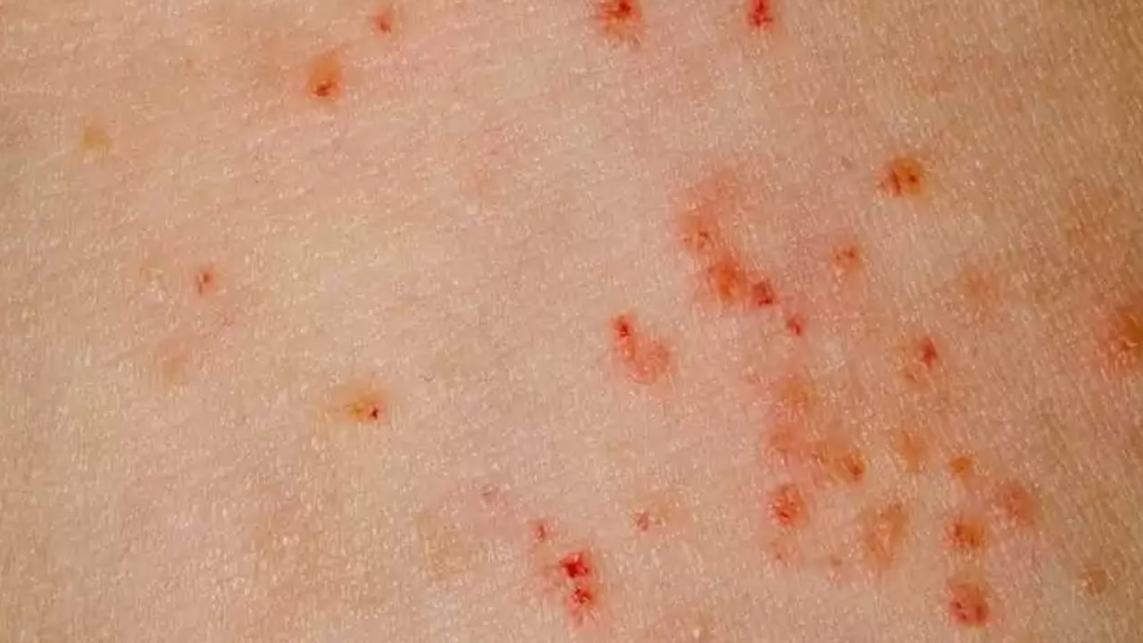 Foto - Yüzde, ayakta, elde egzama neden olur? Testi etkileyecek: Bunları biliyor musunuz? Tüm detaylara dikkat