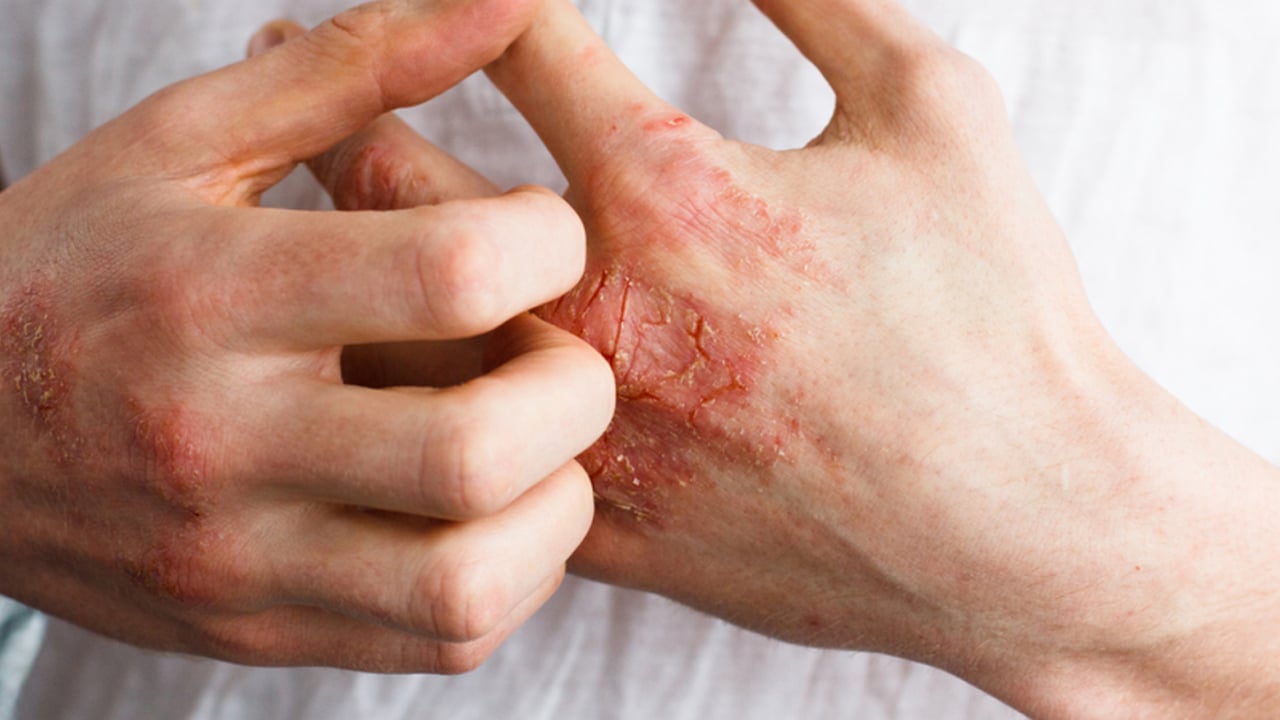 Foto - Yüzde, ayakta, elde egzama neden olur? Testi etkileyecek: Bunları biliyor musunuz? Tüm detaylara dikkat