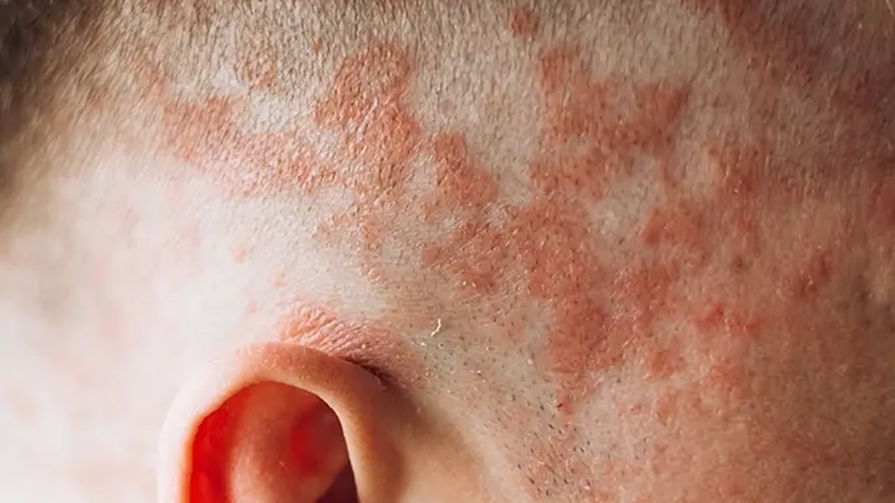 Foto - Yüzde, ayakta, elde egzama neden olur? Testi etkileyecek: Bunları biliyor musunuz? Tüm detaylara dikkat