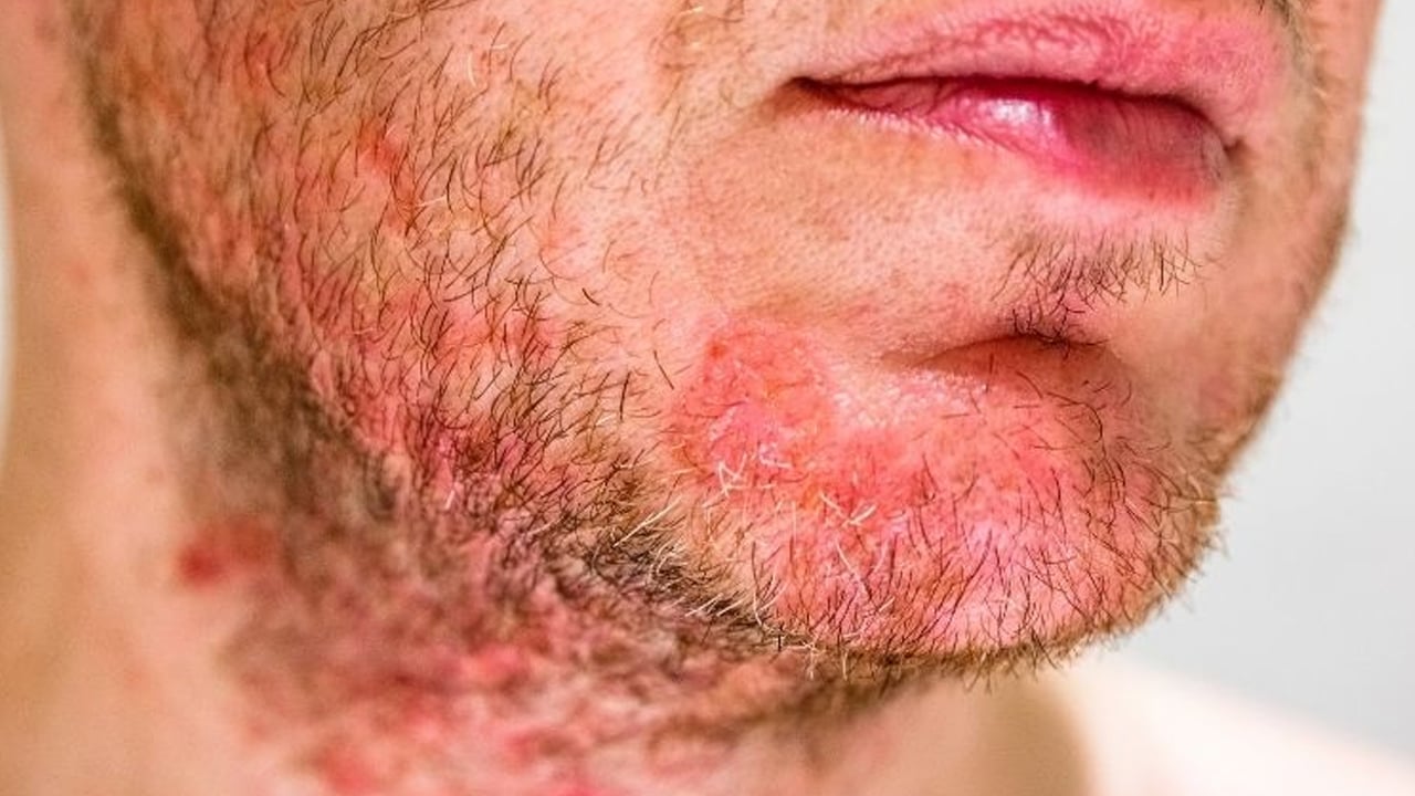 Foto - Yüzde, ayakta, elde egzama neden olur? Testi etkileyecek: Bunları biliyor musunuz? Tüm detaylara dikkat