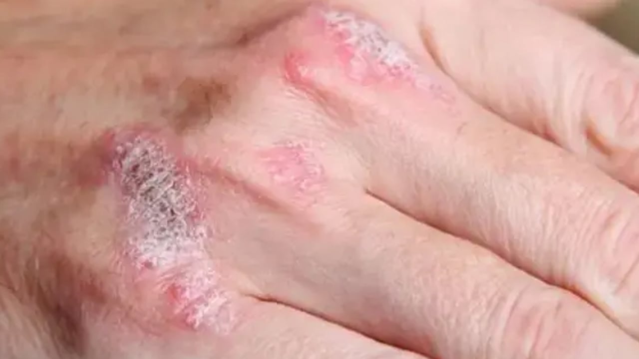 Foto - Yüzde, ayakta, elde egzama neden olur? Testi etkileyecek: Bunları biliyor musunuz? Tüm detaylara dikkat