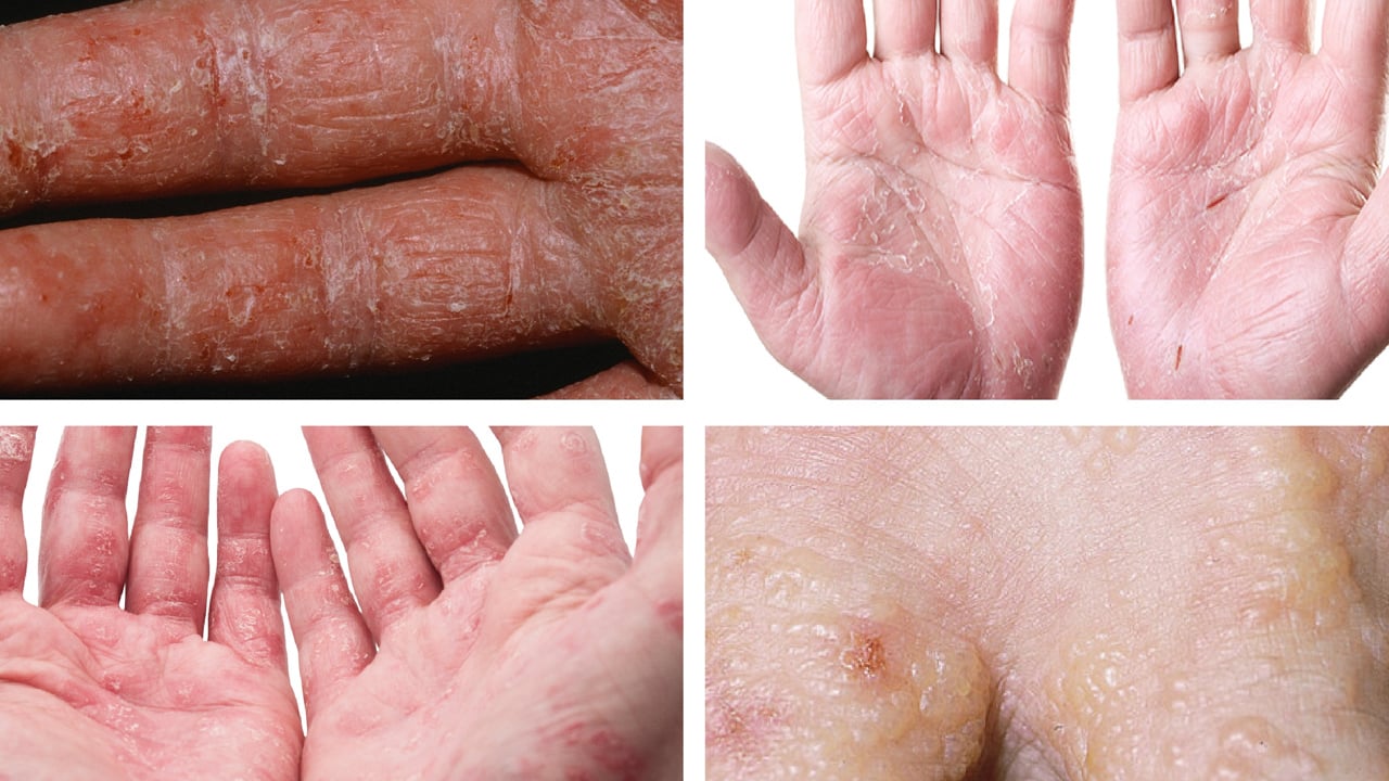 Foto - Yüzde, ayakta, elde egzama neden olur? Testi etkileyecek: Bunları biliyor musunuz? Tüm detaylara dikkat