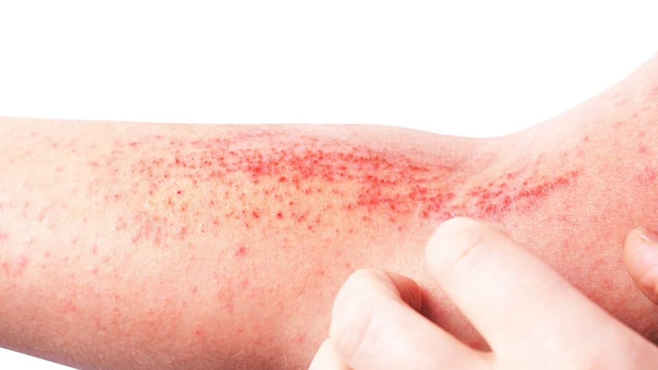 Foto - Yüzde, ayakta, elde egzama neden olur? Testi etkileyecek: Bunları biliyor musunuz? Tüm detaylara dikkat