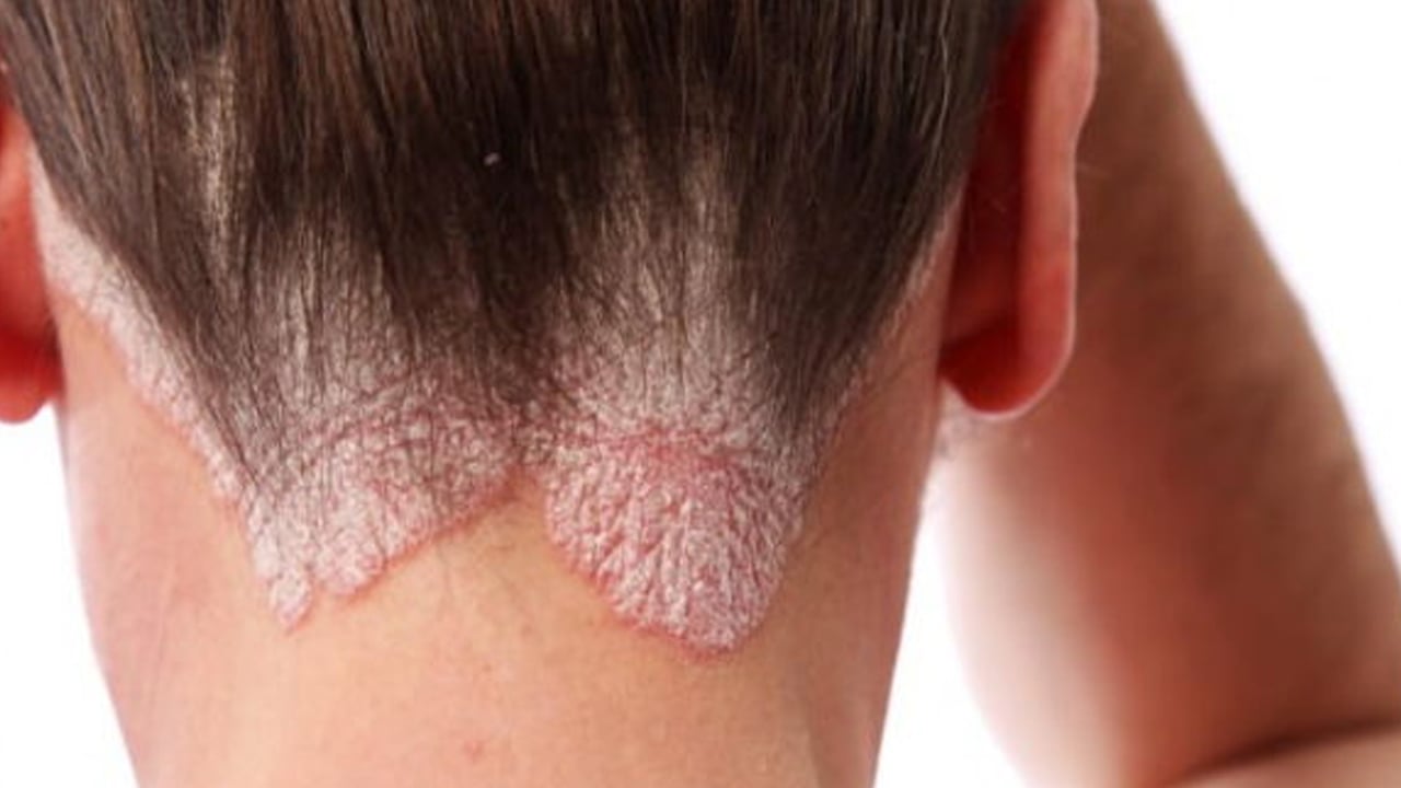 Yüzde, ayakta, elde egzama neden olur? Testi etkileyecek: Bunları biliyor musunuz? Tüm detaylara dikkat