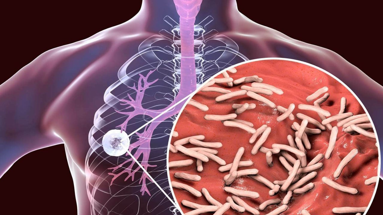 Foto - Yüzyıllık düşman bitmedi: Tüberküloz hâlâ en ölümcül bulaşıcı hastalık