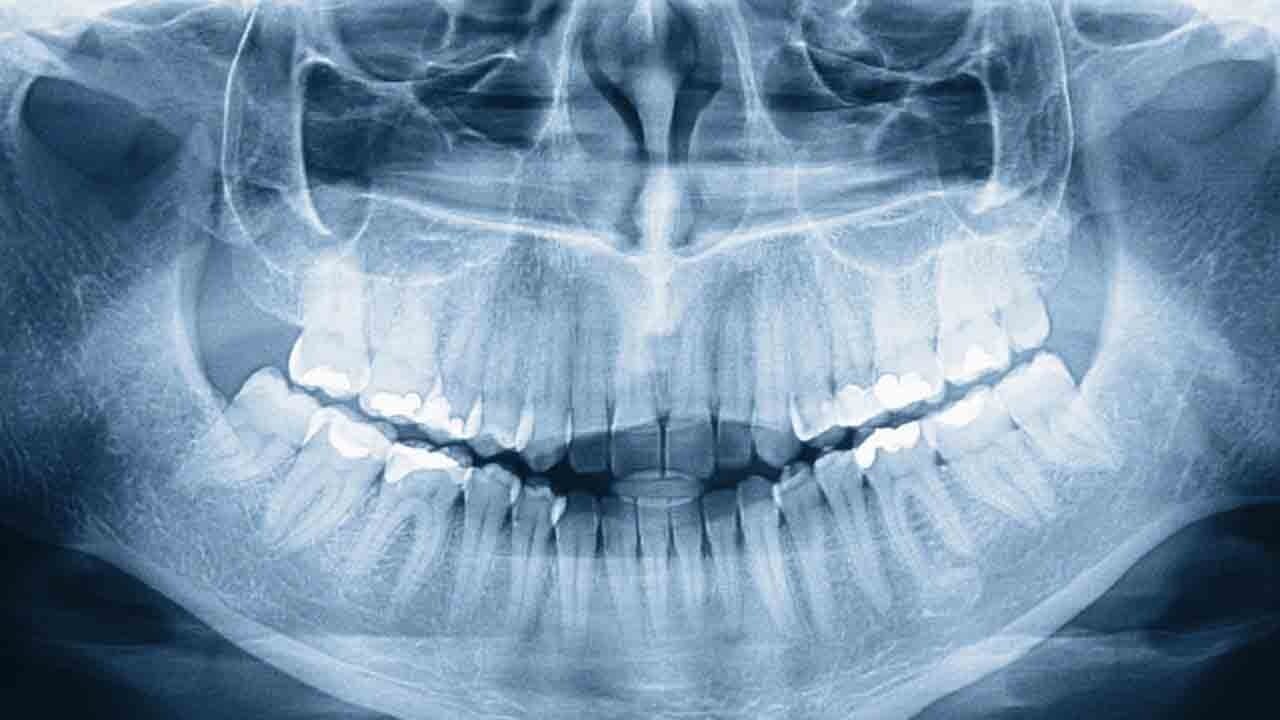 32 değil 42 diş: Fark etmeden dünya rekoru