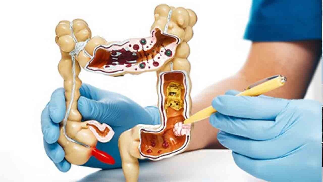 Bağırsakta gizli virüs şüphesi: Kanserin nedenine yeni ipucu