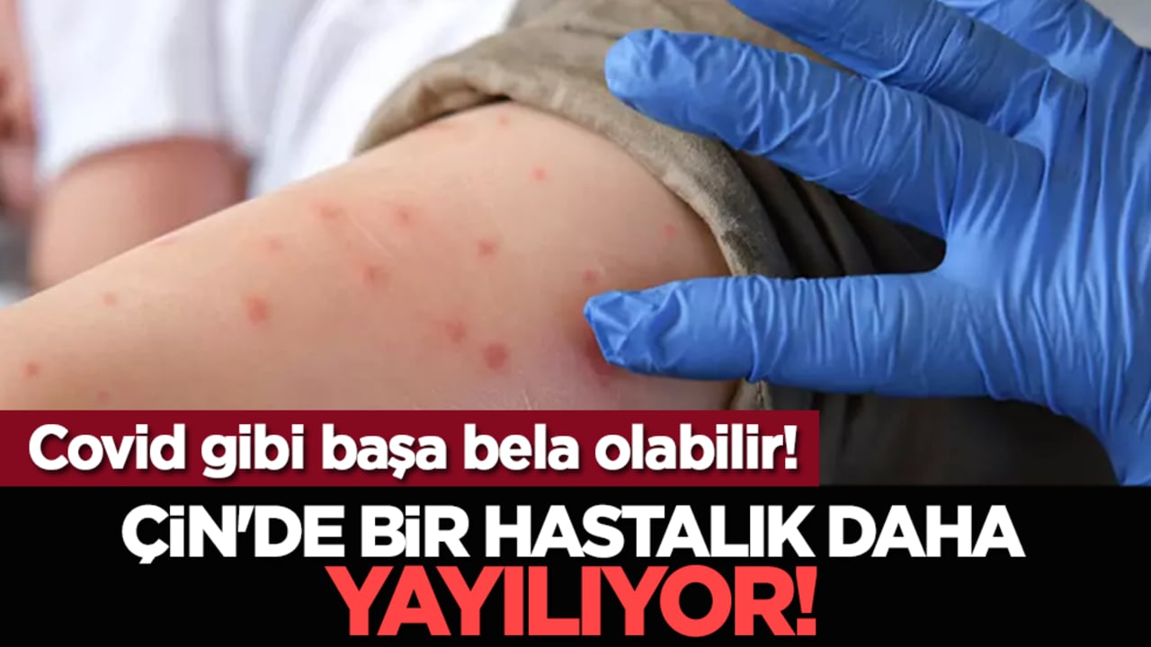 Covid gibi başa bela olabilir! Çin'de bir hastalık daha yayılıyor!