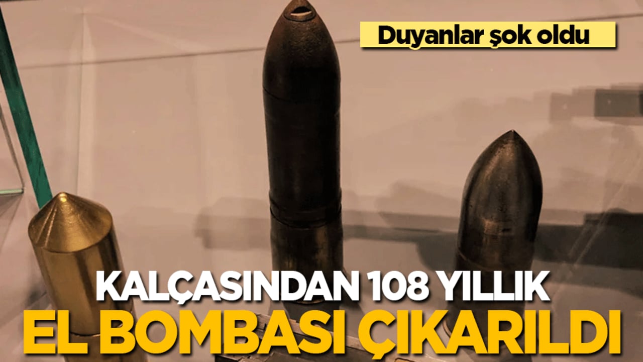 Şaka değil gerçek! Kalçasından 108 yıllık el bombası çıktı
