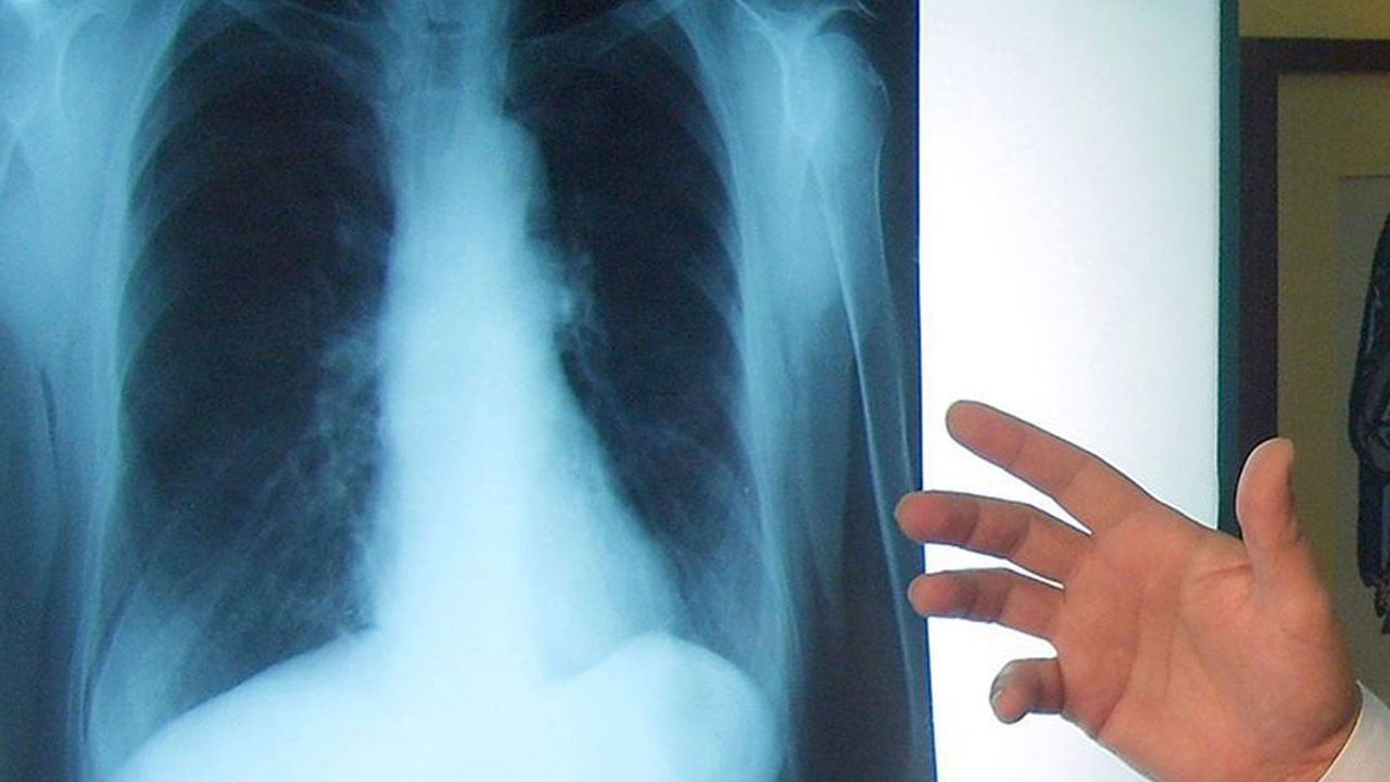 Akciğer kanserinde kritik uyarı! Vakaların yüzde 85’i tek bir nedene bağlı