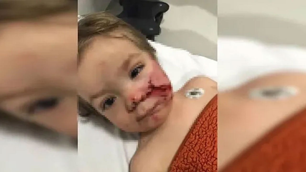 Ankara’da pitbull dehşeti! Yasaklı ırk 2 çocuğu yaraladı