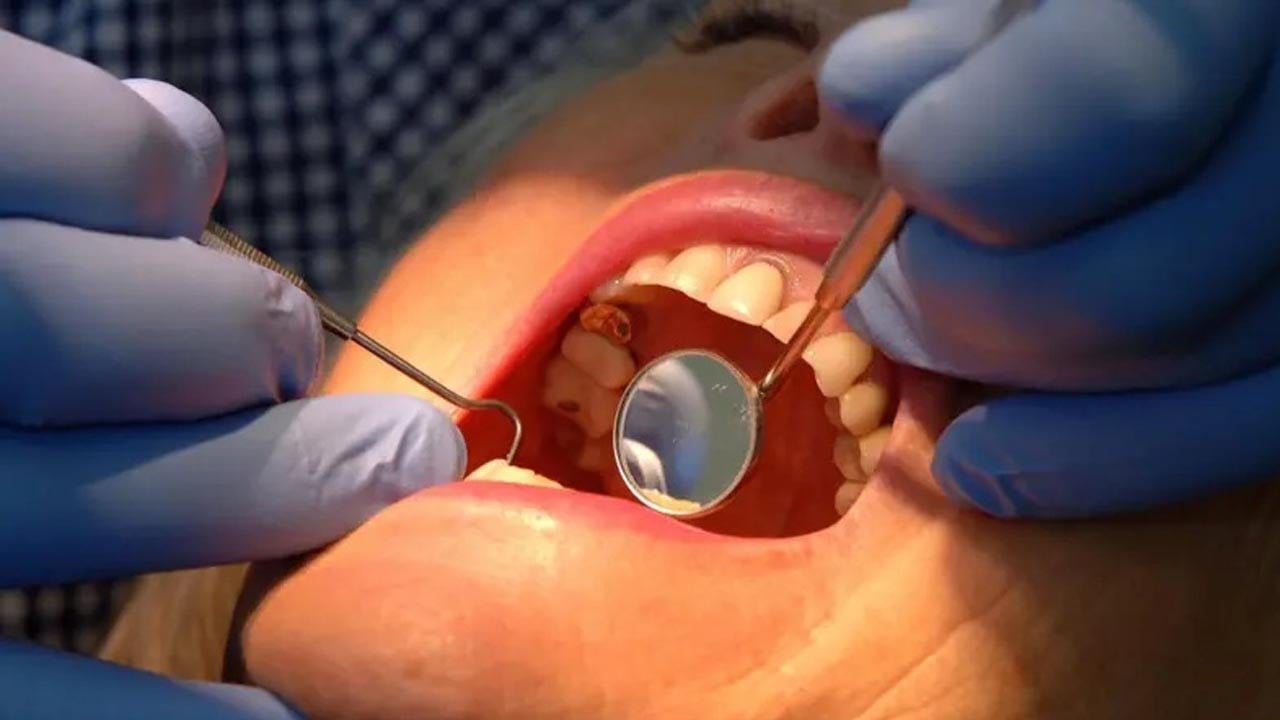 Bilim insanlarından dev buluş: Diş çürüklerini tarihe mi gömecek?