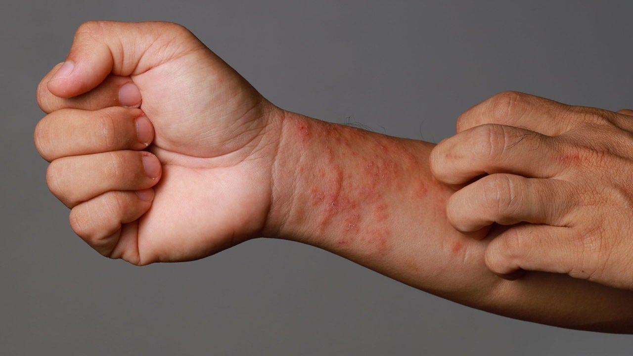 Ciltteki bu belirtileri hafife almayın! Geçmeyen kaşıntının nedeni bu olabilir