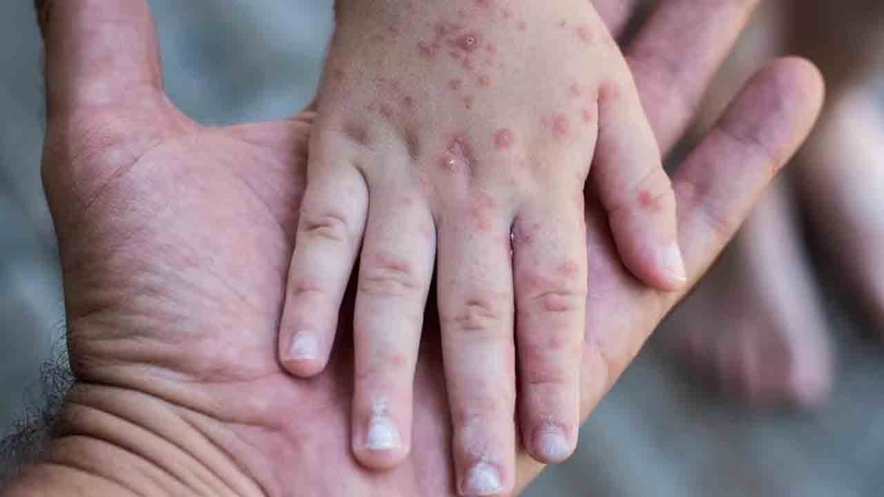 Dikkat! Bu virüs çocuklarda hızla bulaşıyor!