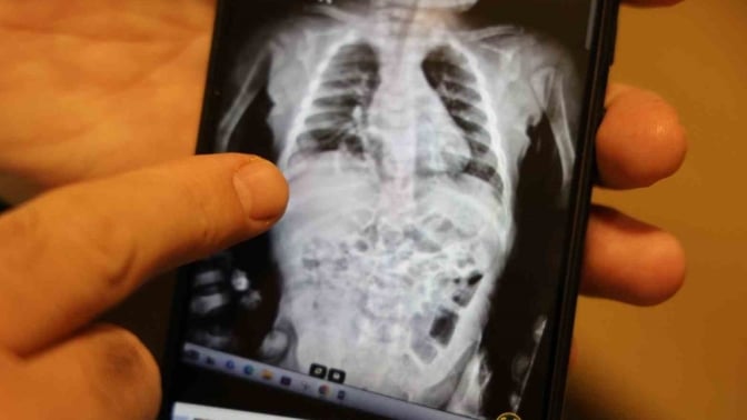 Diyarbakır’da kritik operasyon: Anne karnındaki bebeğin şişen böbreği çürümeden alındı