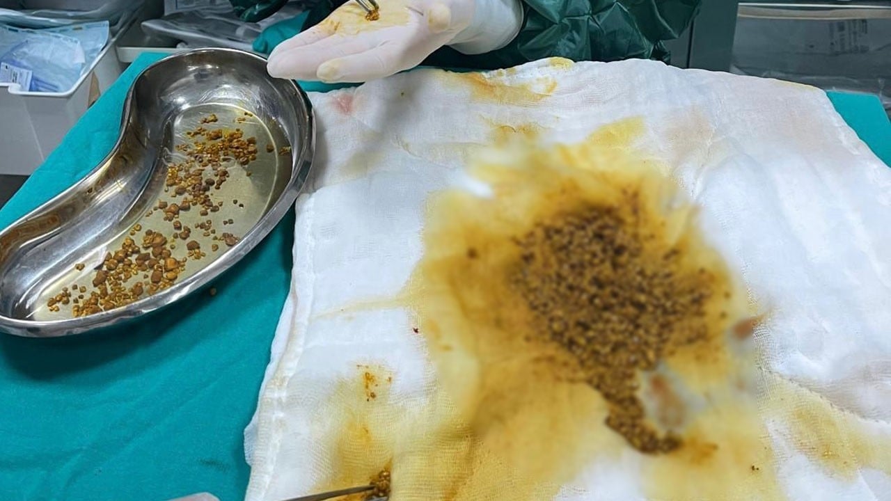 Doktorlar böyle bir vaka ilk kez gördü! Bilin bakalım hastanın safra kesesinden kaç taş çıktı?