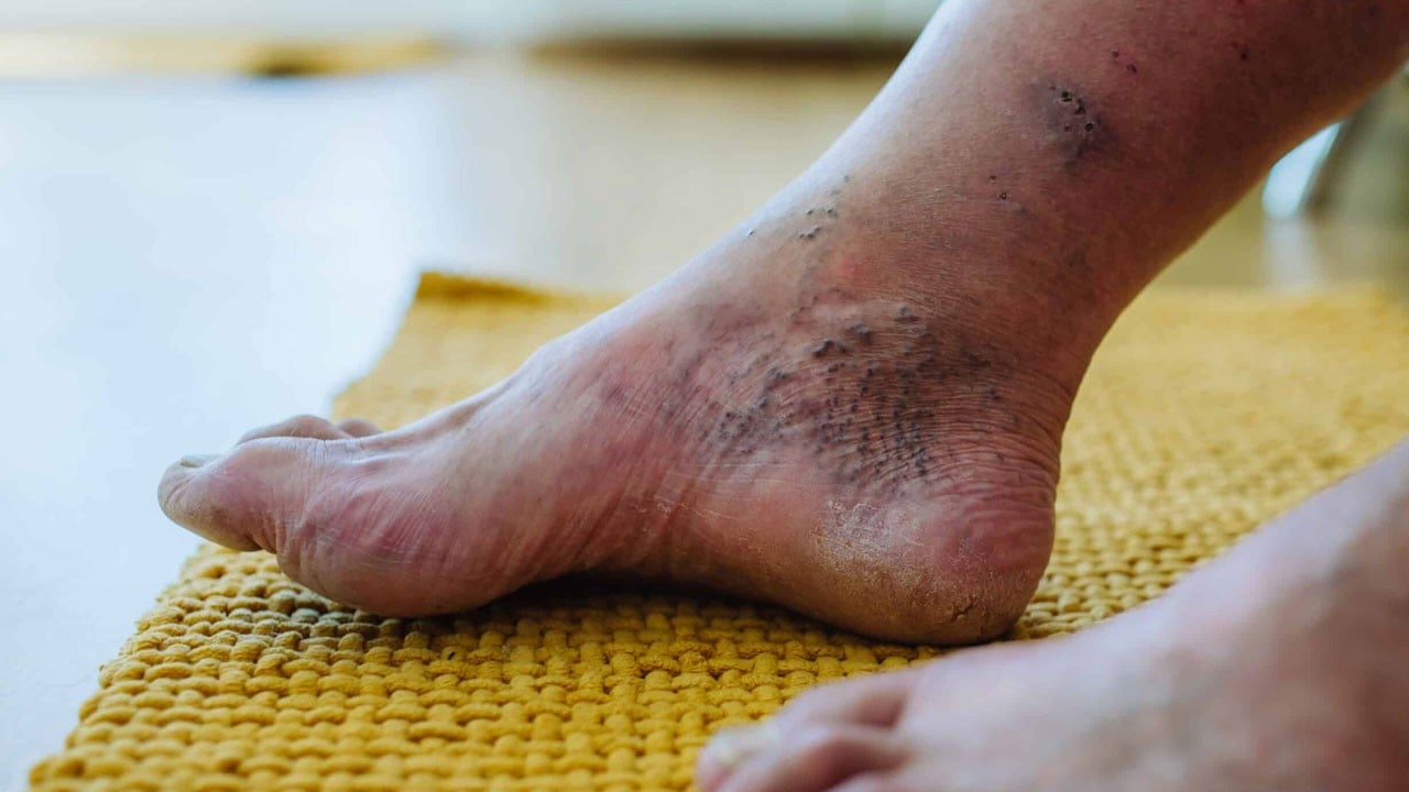 Giderek yayılıyor! Geç kalınırsa uzuv kaybı kaçınılmaz