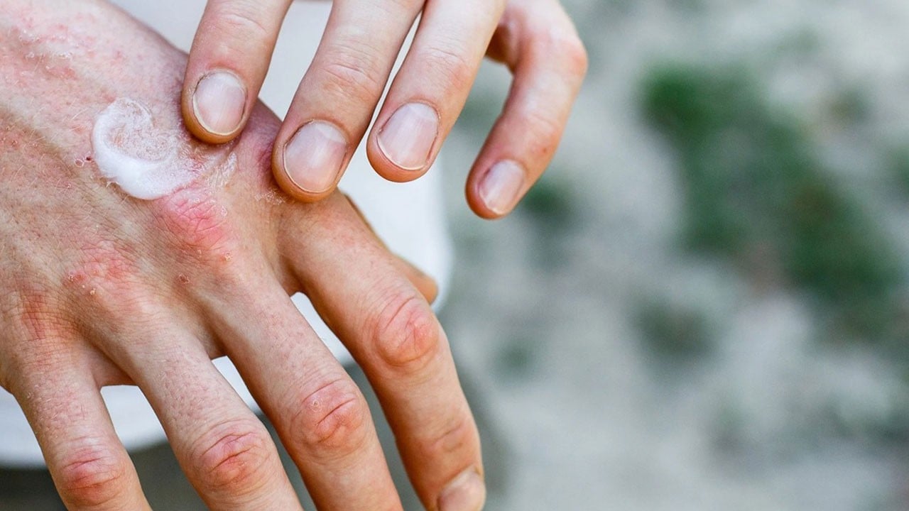 Görmezden gelmeyin! Kışın ciltte başlayan bu belirtilere dikkat