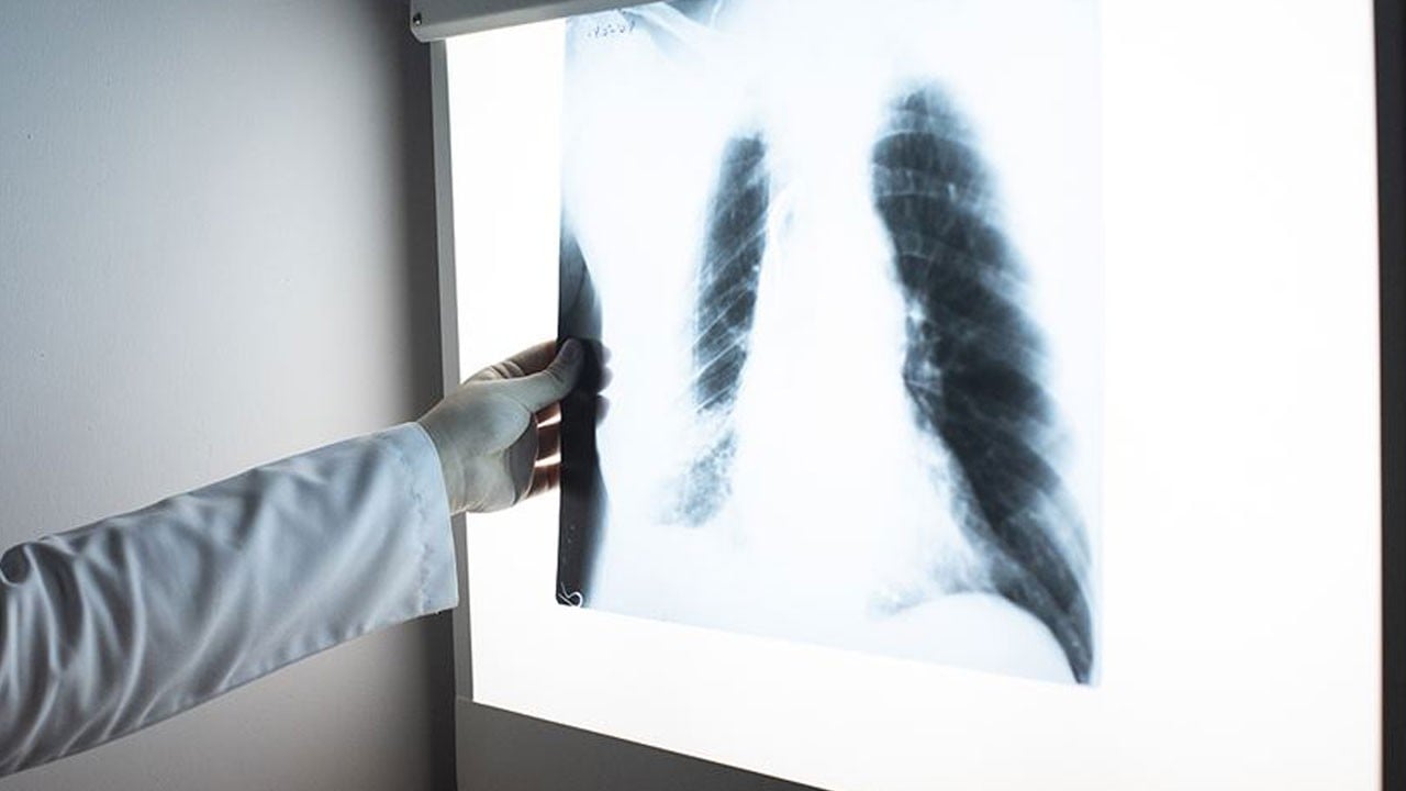 Güvendeyim sanmayın! Yemek buharı bile bu hastalığa yol açıyor