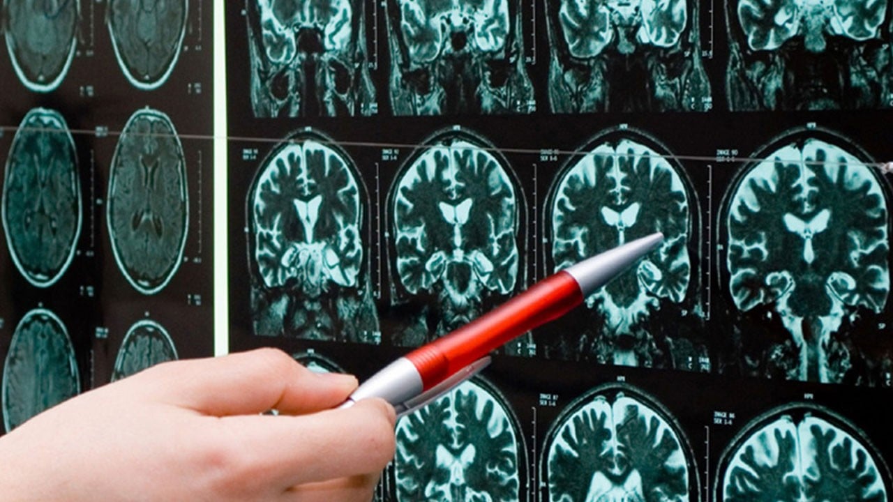 Herkes böyle sanıyor ama gerçek farklı! İşte, epilepsi hakkında en yaygın yanlışlar