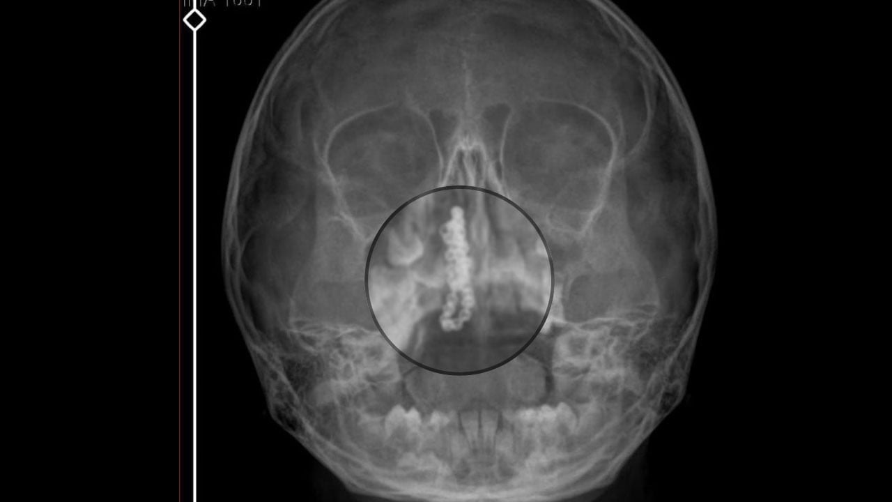 İnanması güç ama 2 sene böyle yaşadı! Küçük kızın burnundan çıkana inanamayacaksınız