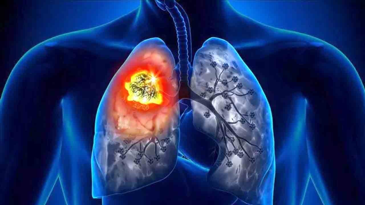 Kanserde tedavi saati önemli: Erken uygulama hayat kurtarıyor