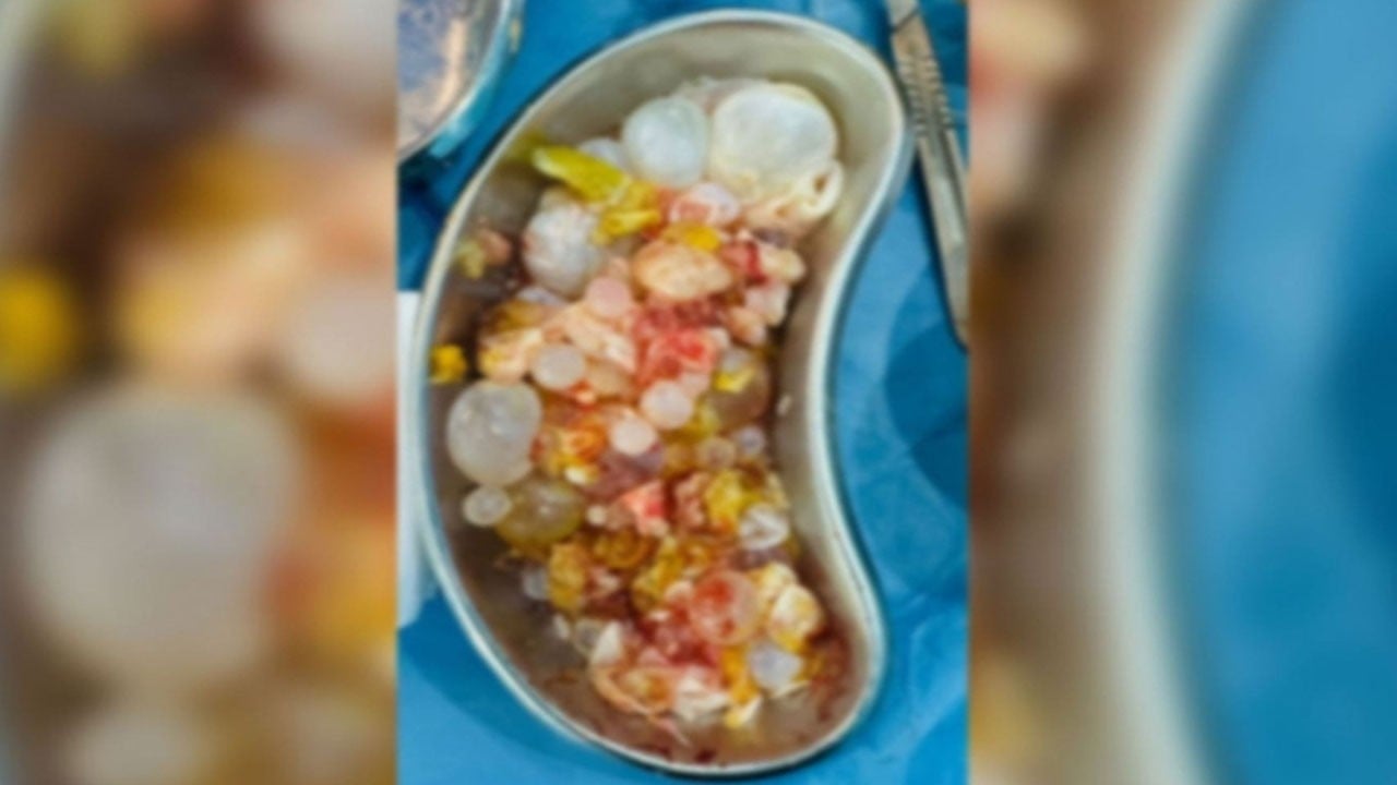 Karın ağrısı ile hastaneye gitti: Karaciğerinden onlarca kurtçuk çıkarıldı