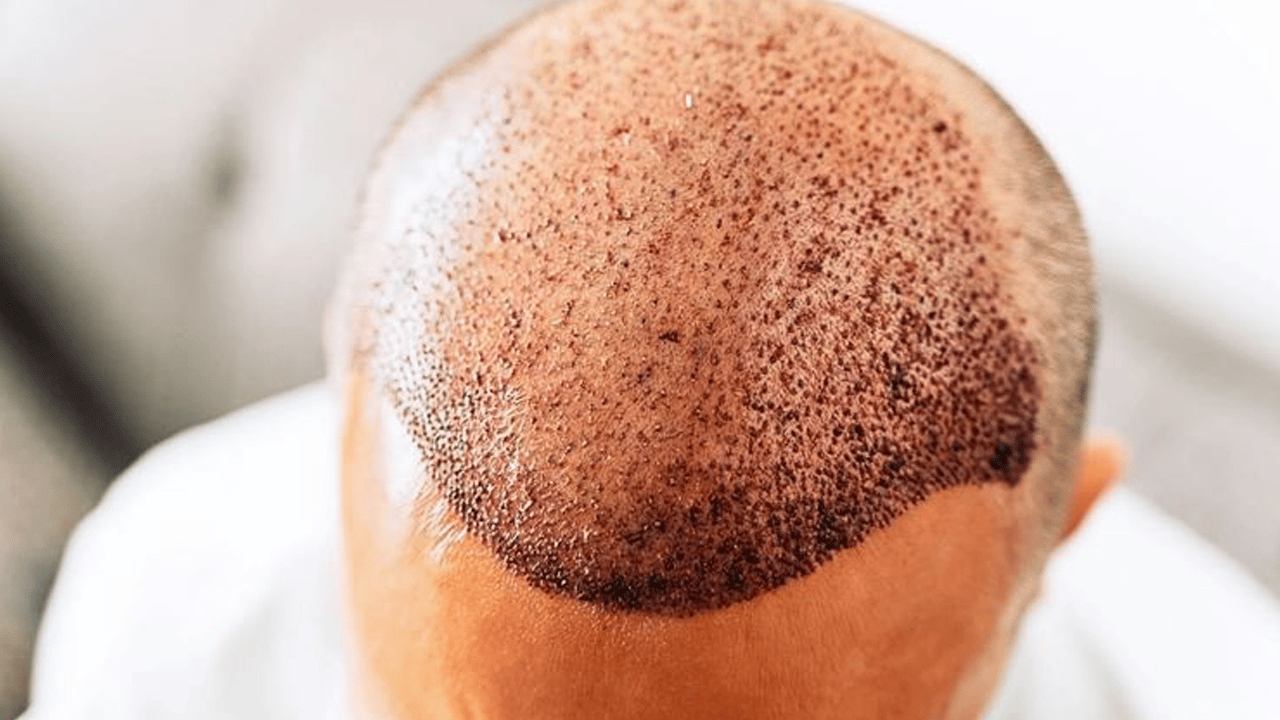 Kelliği bitirecek buluş: 20 günde saç çıkardılar