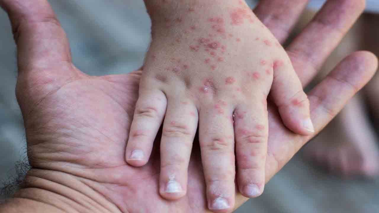 Kızamık ABD’yi sardı: Vakalar hızla artıyor