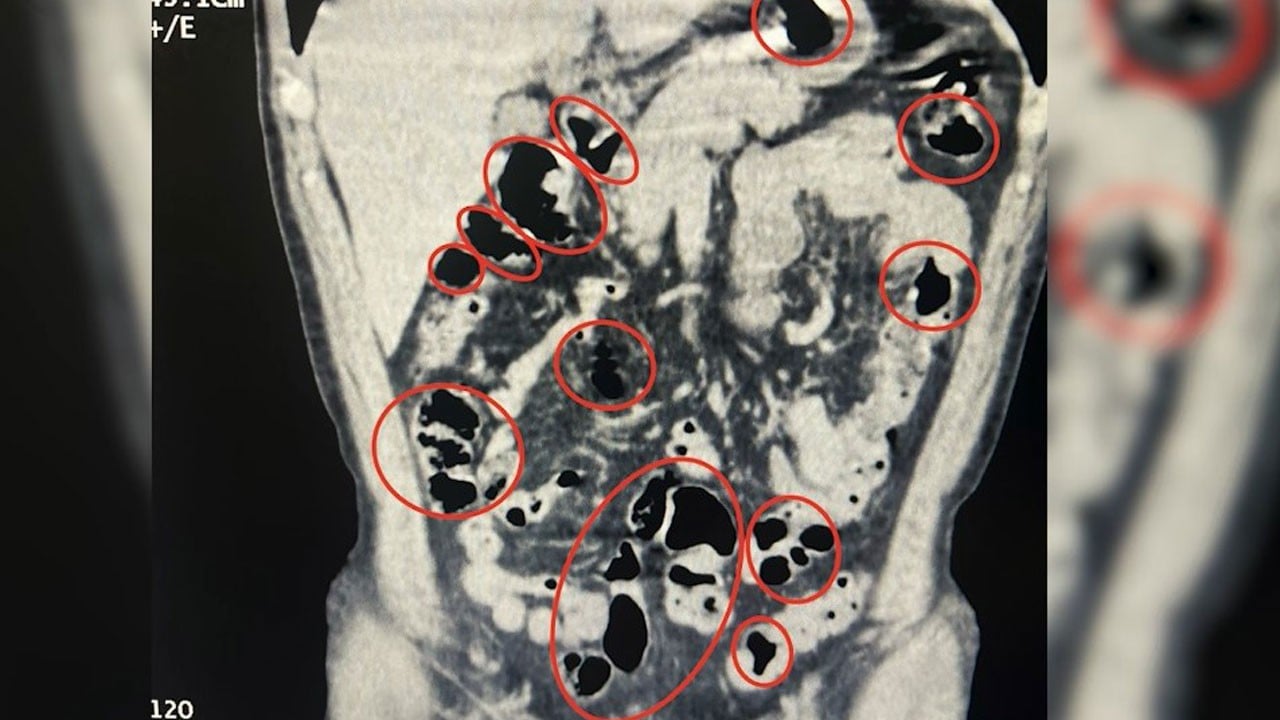 Kontrol noktasında ortaya çıktı! Mide ve bağırsaklarından çıkana inanamayacaksınız