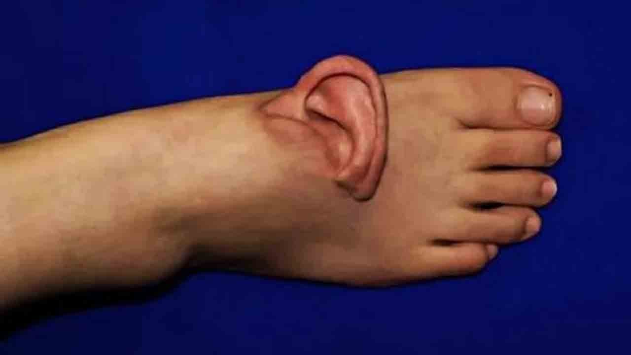 Kopan kulak ayağa dikildi: Yedi ay sonra yerine takıldı