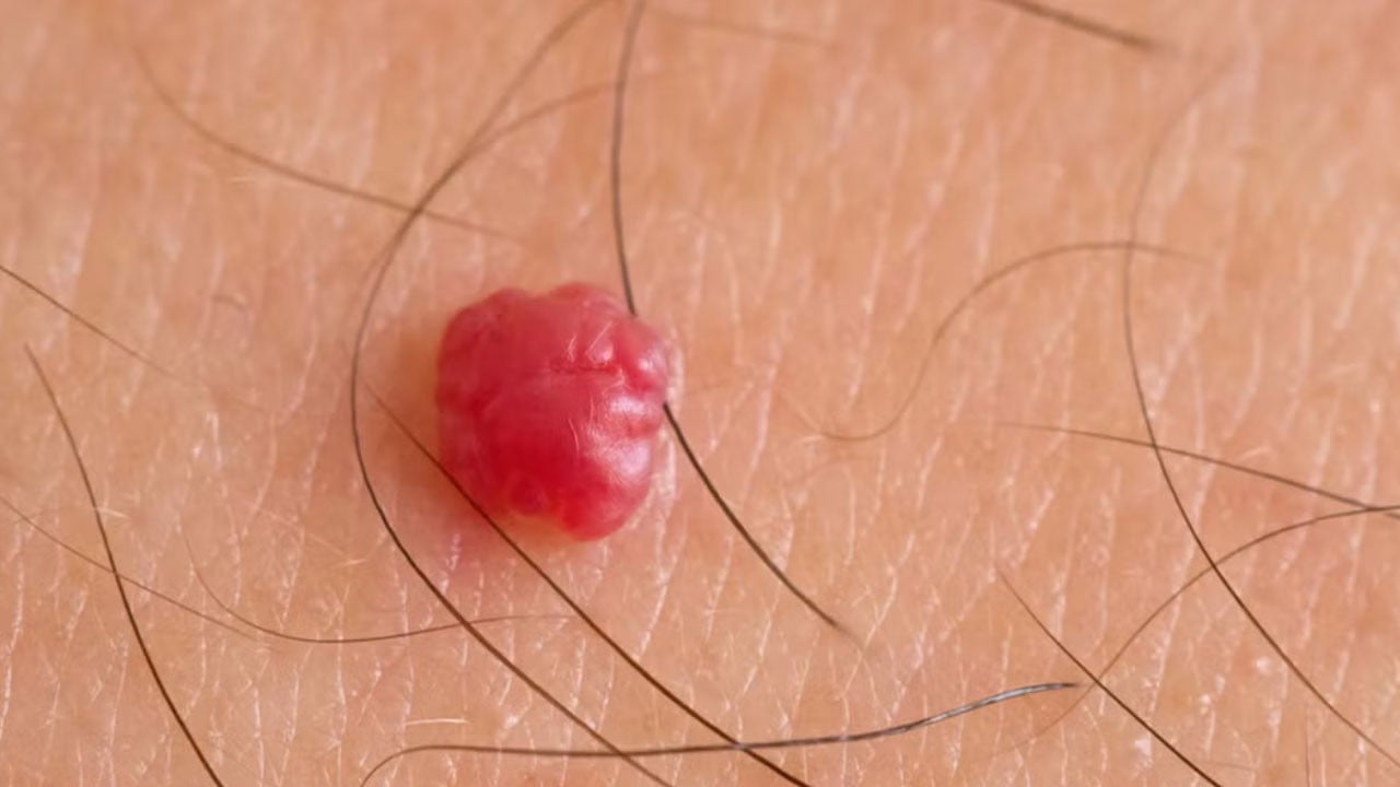 Sakın hafife almayın! Sizin cildinizde de varsa hemen uzmana görünün