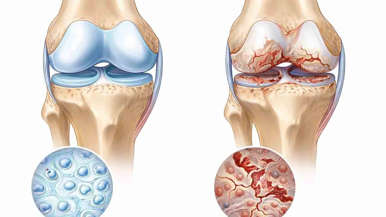 Yaşlı eklemlerde devrim: Yeni tedavi proteze alternatif