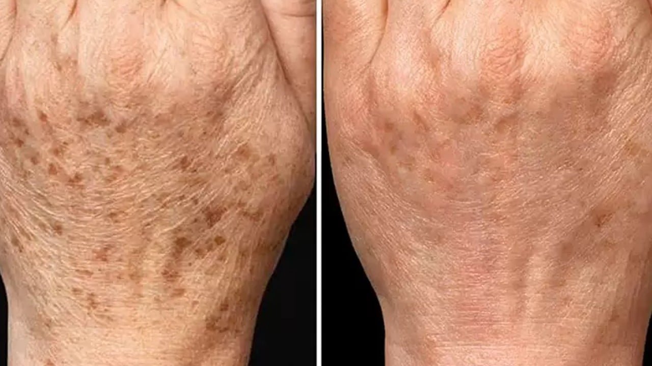  Yaşlılık lekeleri nasıl yok edilir? Büyüme durma çizgileri: 50 yaşındaki ciltte görünür... Püf noktasına bakın ne