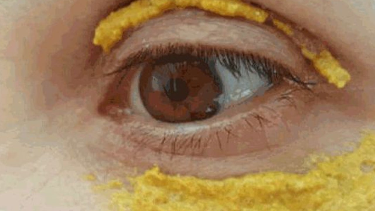 Zerdeçalı gözlerinin etrafına süren bir daha vazgeçmiyor! Sivilce, kırışıklık, morlukları, şişlikleri yok ediyor!