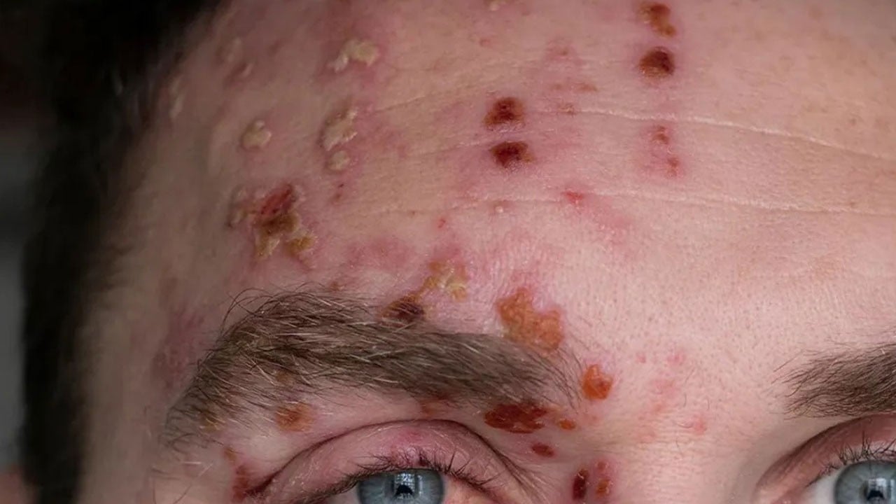 Zona nedir? Evde zona tedavisi nasıl yapılır?