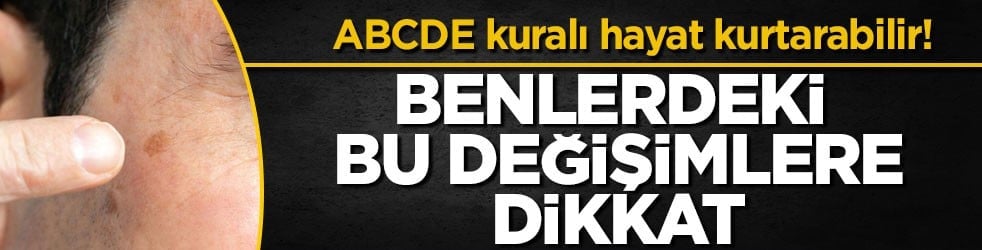 ABCDE kuralı hayat kurtarabilir! Benlerdeki bu değişimlere dikkat