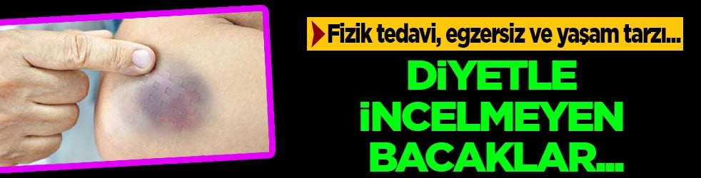 Ayaklarınız iflas etmesin aman dikkat! Hekimden lipödem işareti olabilir açıklaması...