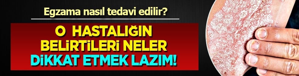 Bana uğramaz demeyin! Egzama nedir, nasıl oluşur ve nasıl geçer? Tek tek bunları not almalısınız...