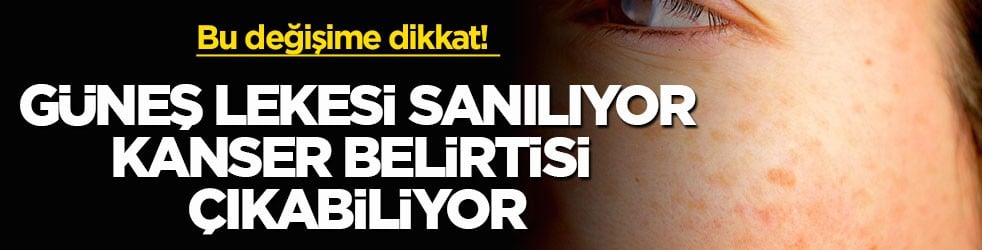 Bu değişime dikkat! Güneş lekesi sanılıyor, kanser belirtisi çıkabiliyor
